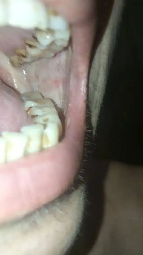 口腔已纤维化内壁不平有痛感