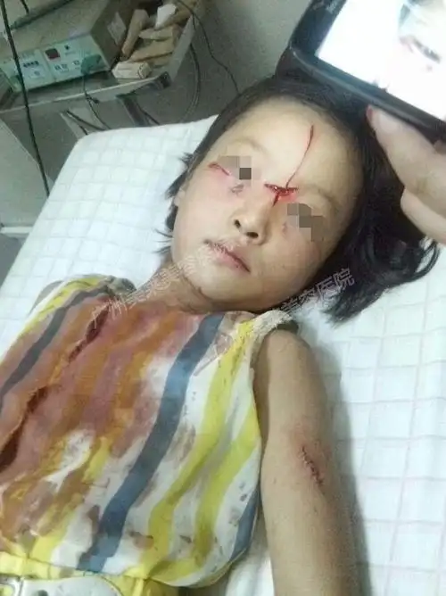 【广州电视台】遭割脸"疤痕女孩"无法回乡上学 留广州治疗"保脸"