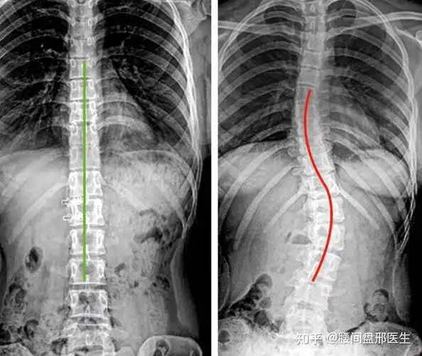 家长慌了央视发声中国中小学生脊柱侧弯人数已超500万赶紧来查