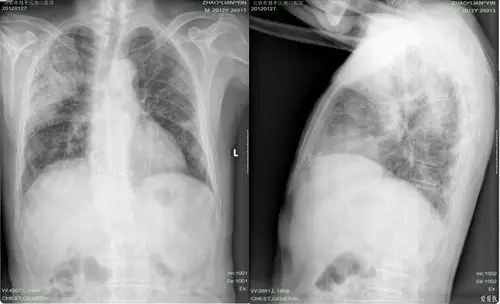 少见病例病史资料全蜂窝肺高手来帮着诊断一下