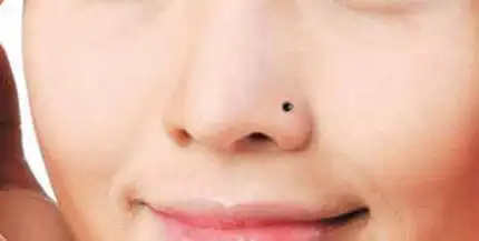 鼻翼上恶痣不会爆富图