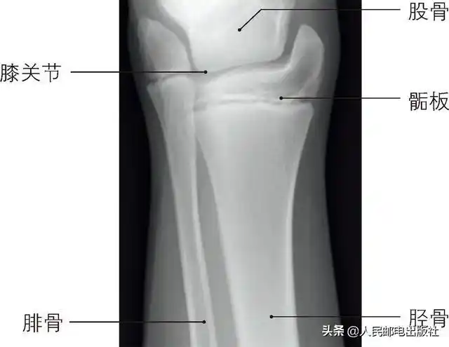 膝关节 x 光片,显示了股骨与胫骨的接合,以及胫骨和腓骨的骺板  gilo