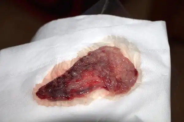 这个是流产还是子宫内膜脱落还是多囊自己排出