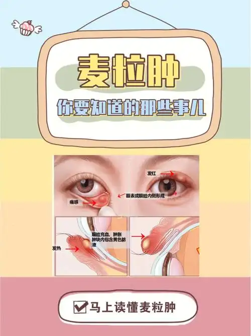 90麦粒肿,俗称"针眼",是一种常见的眼科疾病75你知道得了麦粒肿