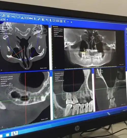 朗视大视野专业口腔cbct特点