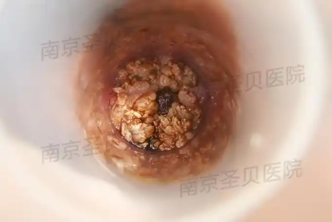 肛内尖锐湿尤图