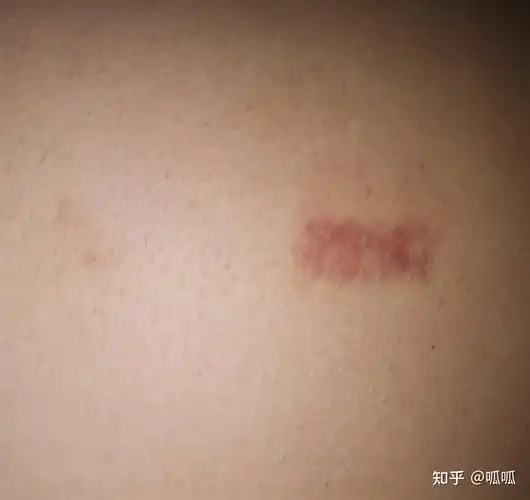 老公后背的吻痕