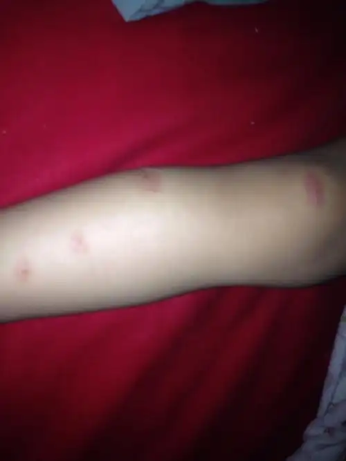 问:两周岁女宝宝最近几天腿上起了好多红色的一片一片的 还特别痒