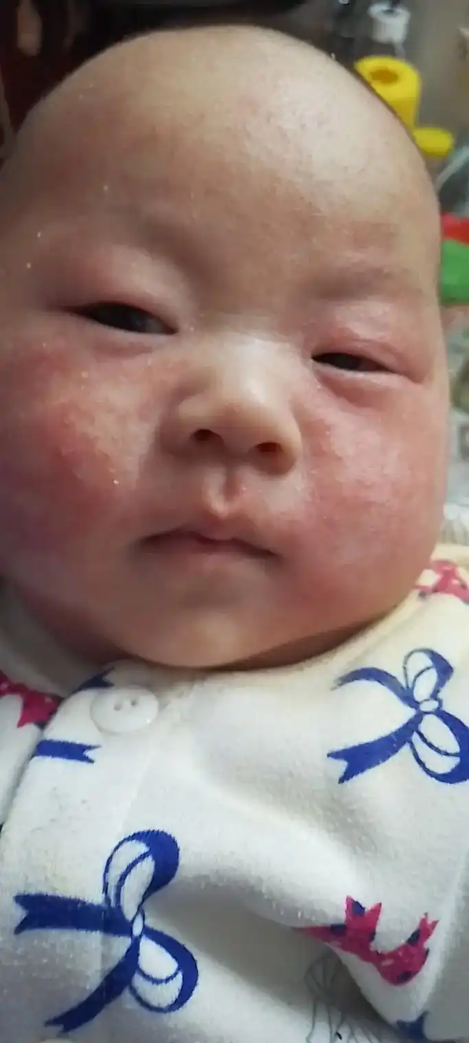 宝宝严重热疹,看着可难受了.爸爸最近经常出差,妈妈背着你接姐 - 抖音