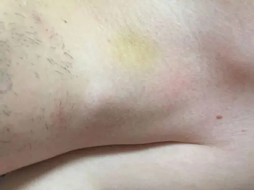 如果是大概是几天的吻痕?