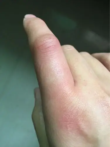 哺乳期艰辛,今早居然被蜈蚣咬了.