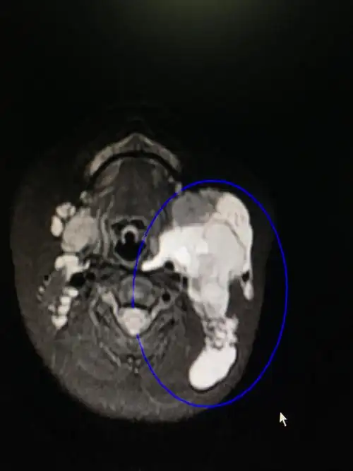 淋巴管瘤,淋巴管畸形如何治疗?能根治吗,会复发吗,留疤吗