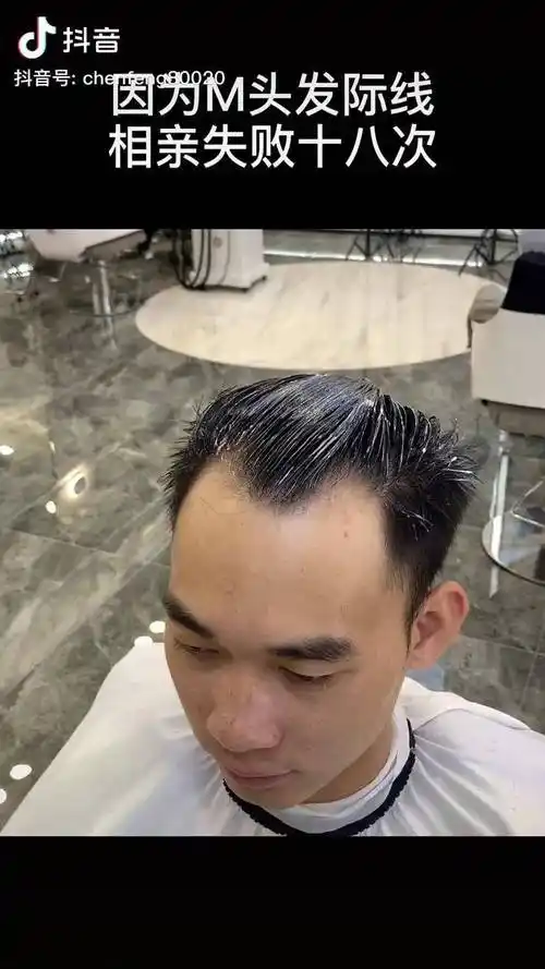 很多网友一直困扰的m字发际线高额头今天来了做完改变真的很大男士