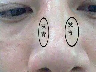我今年30岁,已经有2年多,鼻梁两侧发青,劳累后加重,休息充足后恢复