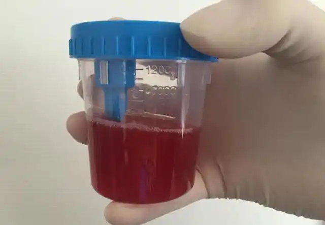 去厕所的时候发现自己的尿液竟然变成了酱油色