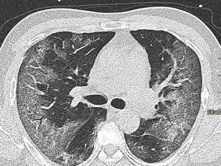 总结新型冠状病毒肺炎的影像学特征│以影识病
