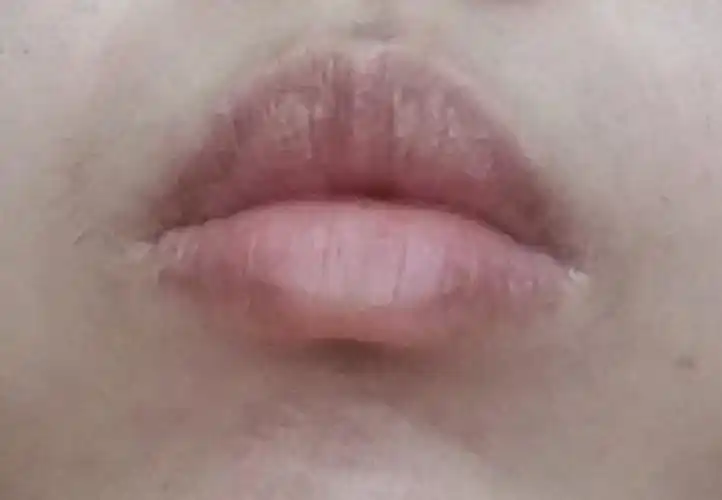 求辨证 皮脂腺异位症 唇色暗沉