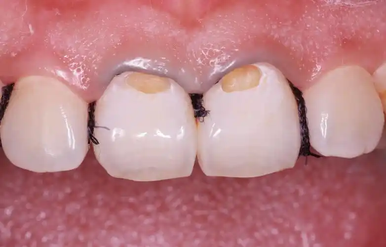 可乐正悄悄的腐蚀了你的牙,你知道吗?