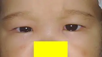 婴儿性(先天性)内斜视
