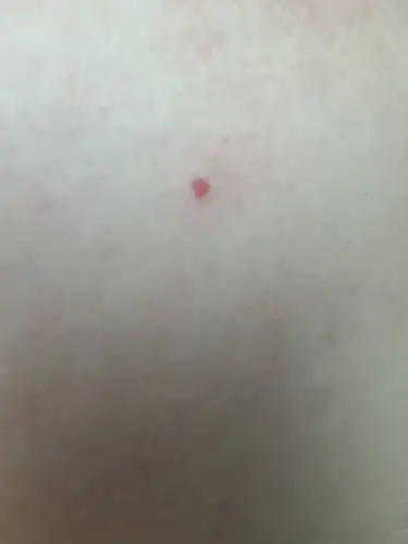 前胸小红点,这是什么情况,不疼不痒,没感觉