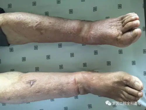 图1 双下肢前侧凹陷性水肿图2 双下肢背侧凹陷性水肿病例简介:59岁