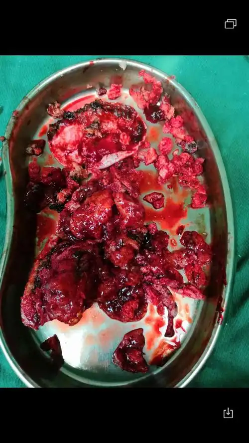 头顶生疮竟是恶性脑肿瘤,妙手仁医一朝除