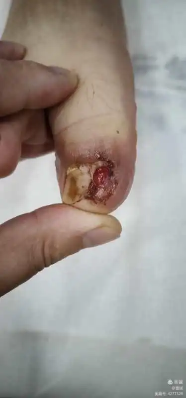 如果是因外伤导致手指甲和肉分离,分开的指甲要剪掉,以免坏死,然后等