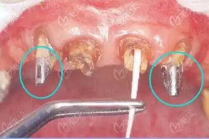 牙齿打桩用金属好还是纤维好 修复前先看金属桩和纤维桩的区别及优