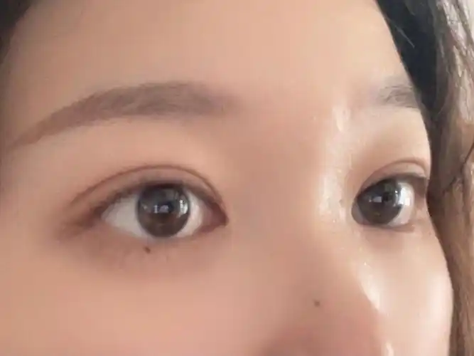 双眼皮埋线第23天