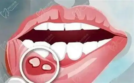 五个小妙招巧治口腔溃疡简单快速治口腔溃疡的方法