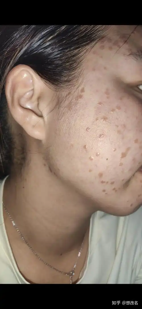 记录扁平疣爆发,争取一个月痊愈