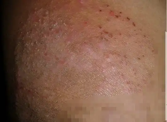 体股癣初期现象图片8