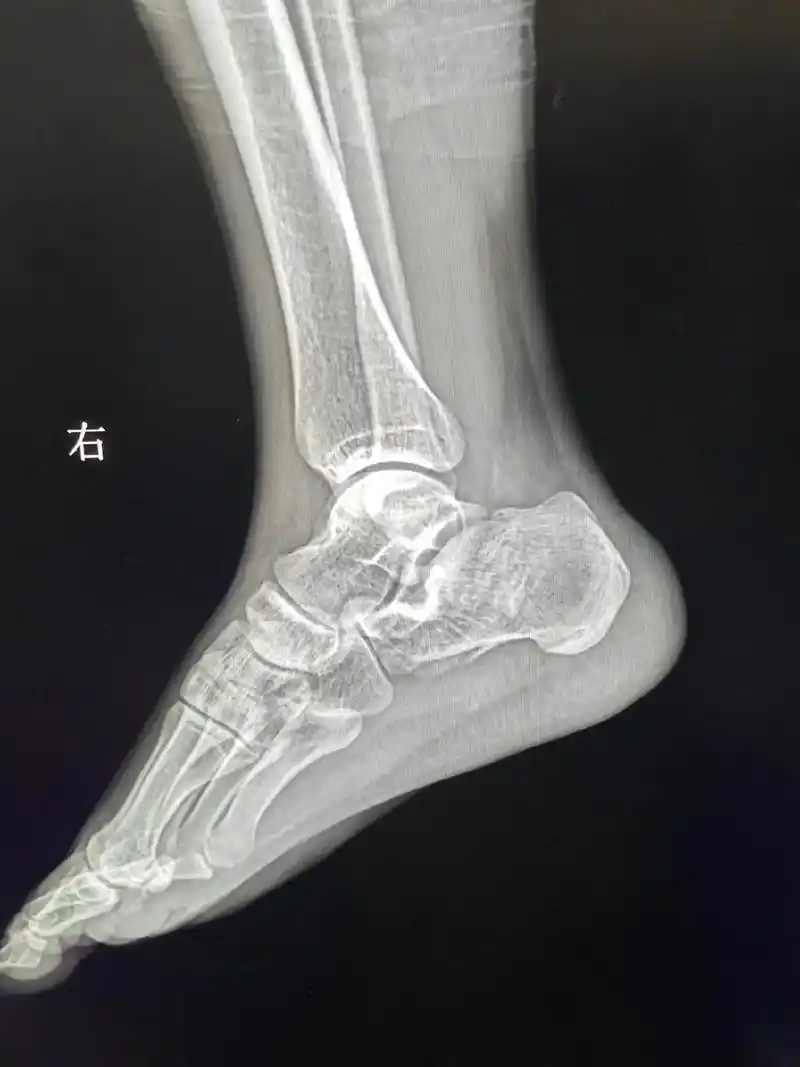 高处坠落脚跟着地—右跟骨粉碎性骨zhe#医学影像 - 抖音