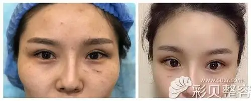 自体脂肪填充太阳穴凹陷前后对比图