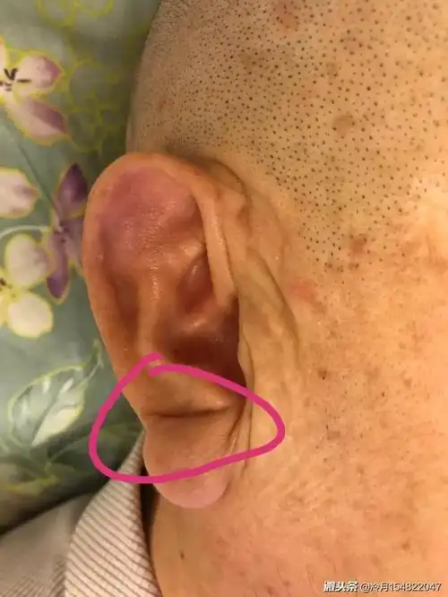 辟谣耳垂有褶皱有一条横纹这可以作为判断冠心病的依据吗