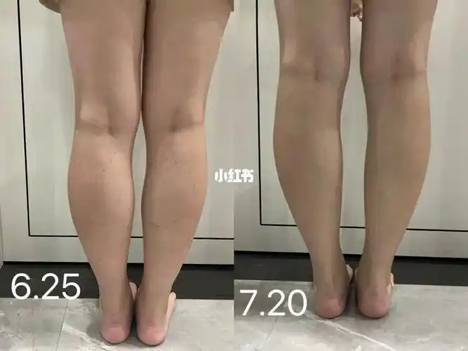 瘦腿针一个月对比图