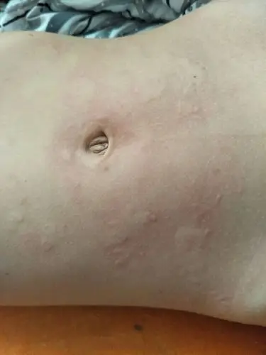 晚上睡觉时候只喝了奶粉!最近前几天有出现过,当过敏治了!