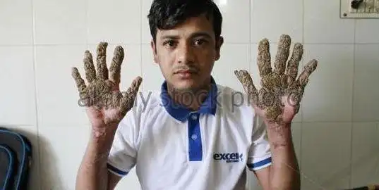 树人孟加拉出现树人双手像树皮怎么回事