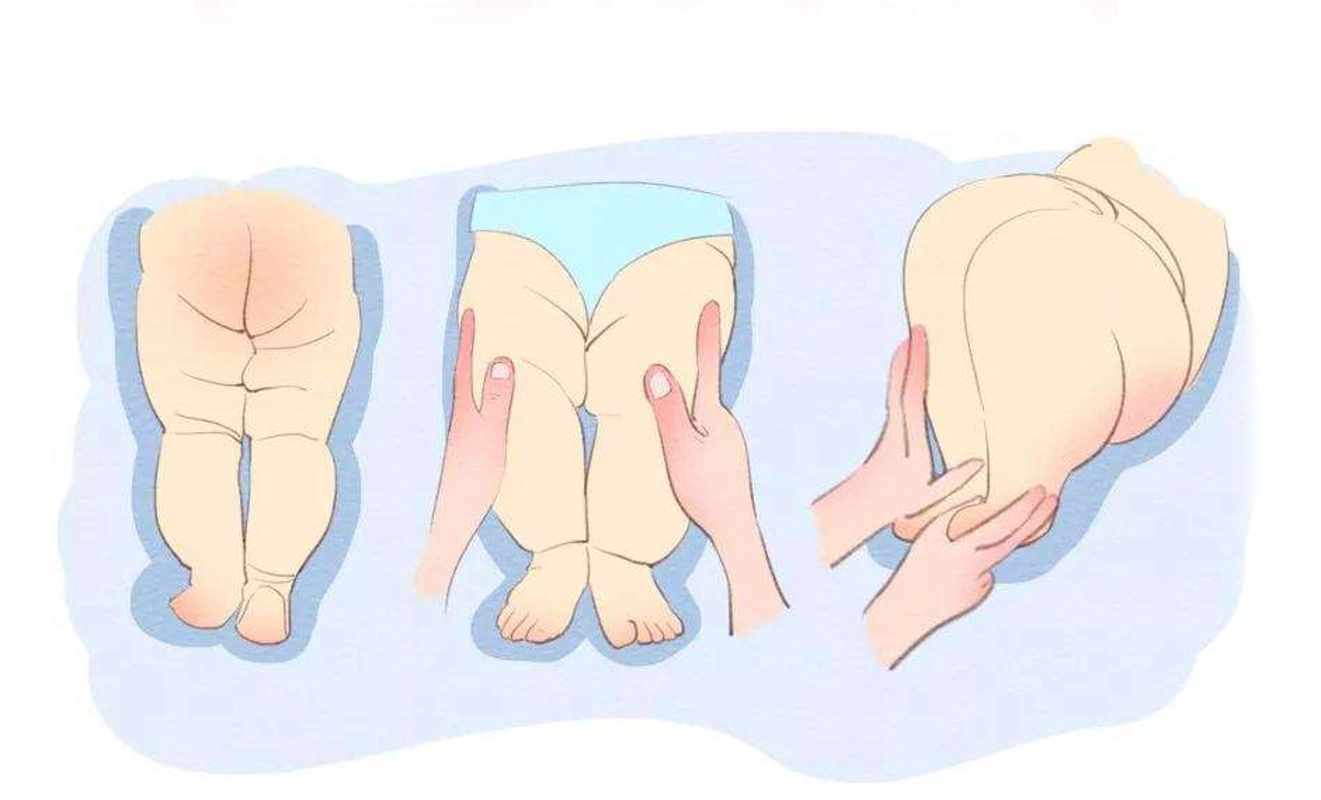 当心新生儿髋关节脱位,工作鼬分享给您其症状与护理办法!