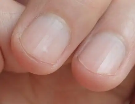 指甲上的竖线与健康无关?