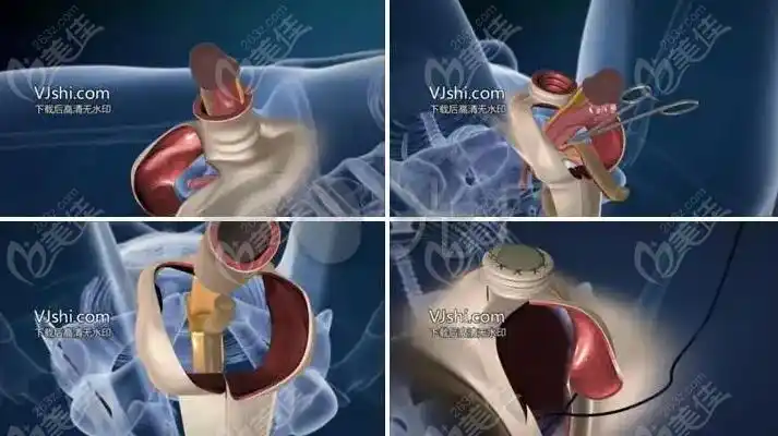 女变男变性手术操作图示