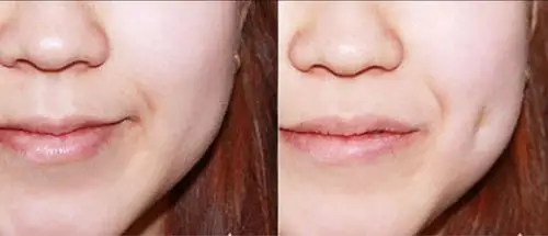 酒窝整形真实图片