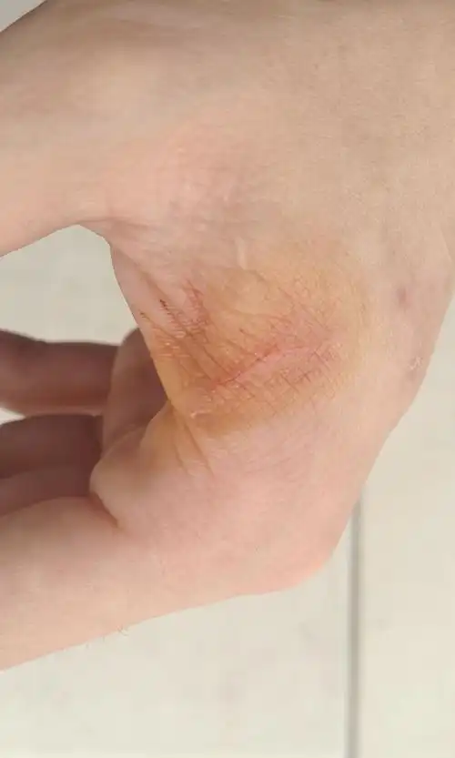 被养了一两个月的家猫抓伤伤痕有点长不算深伤口出血当时