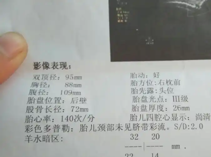 孕妈做产检时,b超单上若有这3种表现,准爸爸或许