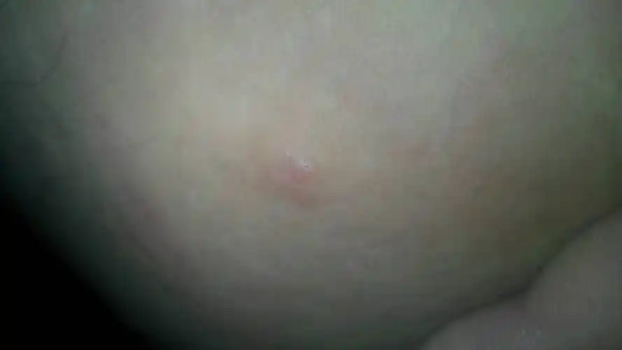 大腿内侧长了个东西这是什么