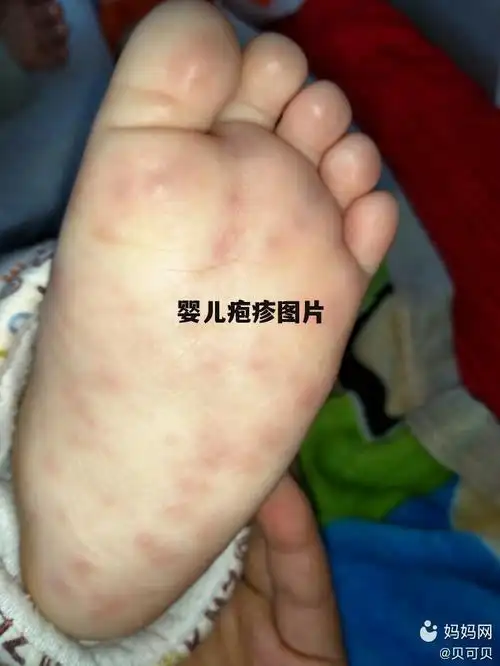 婴儿疱疹图片初期症状 婴儿疱疹图片