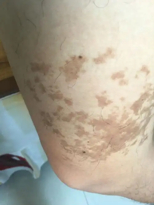 炎症后皮肤色素沉着吗j