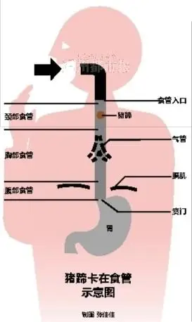 猪蹄卡在食管里 手术做了一个多小时才解除险情