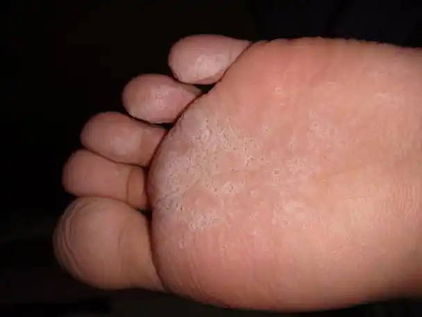 治疗脚气的5个偏方!