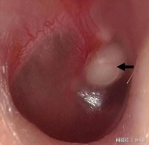 三岁女儿突然听不清楚耳朵流脓原因是耳里长了颗白色珍珠
